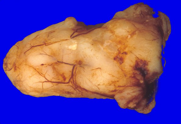 6A1 Ependymoma, cervical spinal cord (Case 6) gross