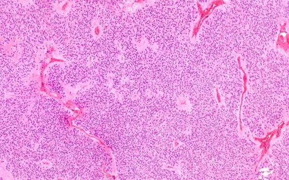 6B1 Ependymoma, cervical spinal cord (Case 6) H&E 10X