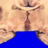 7A1 Ependymoma, Anaplastic (Case 7) 2