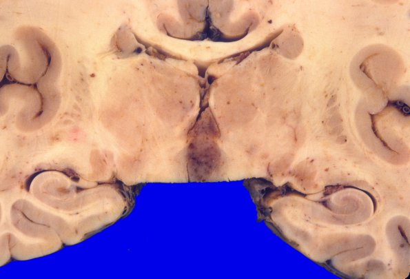 7A1 Ependymoma, Anaplastic (Case 7) 2