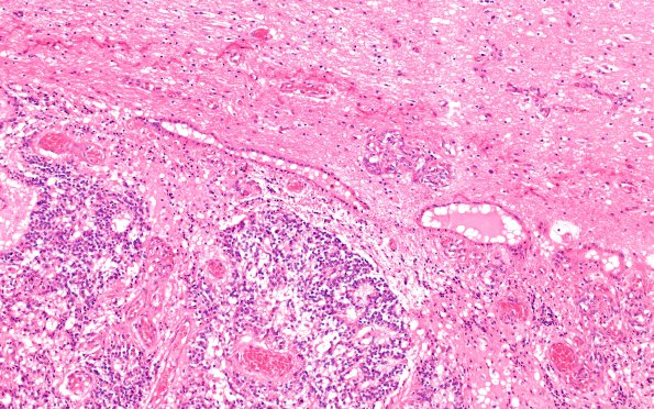 7A3 Ependymoma, anaplastic (Case 7) N6 10X