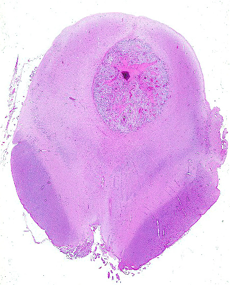 7B2 Ependymoma, anaplastic (Case 7) N6