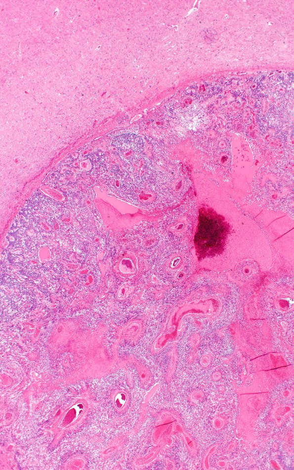 7B3 Ependymoma, anaplastic (Case 7) N6 2X A