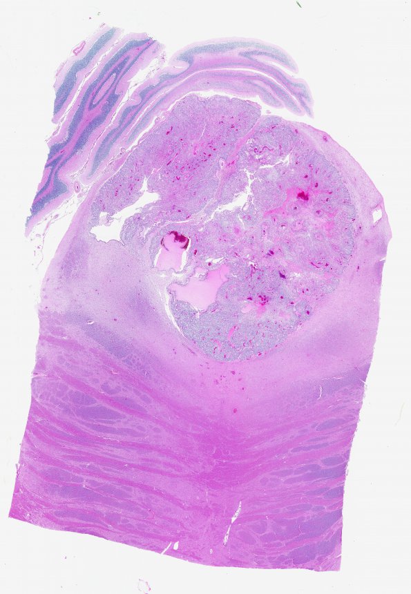 7C2 Ependymoma, anaplastic (Case 7) N7