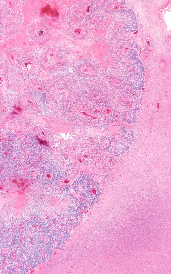 7C3 Ependymoma, anaplastic (Case 7) N7 2X