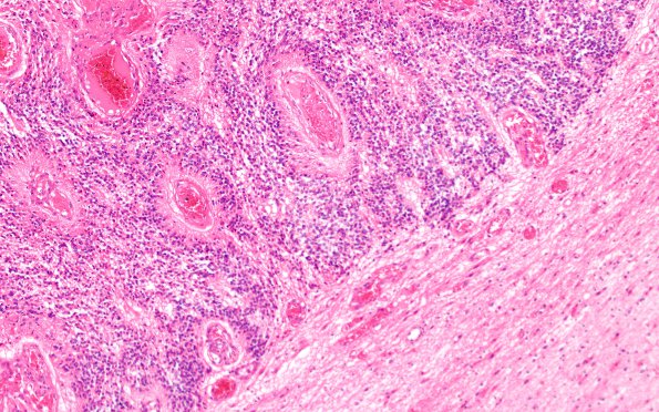 7C4 Ependymoma, anaplastic (Case 7) N7 10X