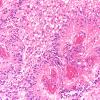 7C5 Ependymoma, anaplastic (Case 7) N7 20X