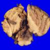 7D1 Ependymoma, Anaplastic (Case 7) 4