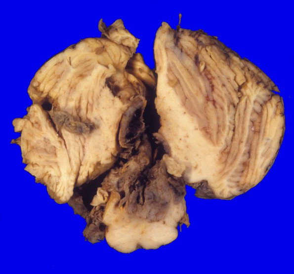 7D1 Ependymoma, Anaplastic (Case 7) 4