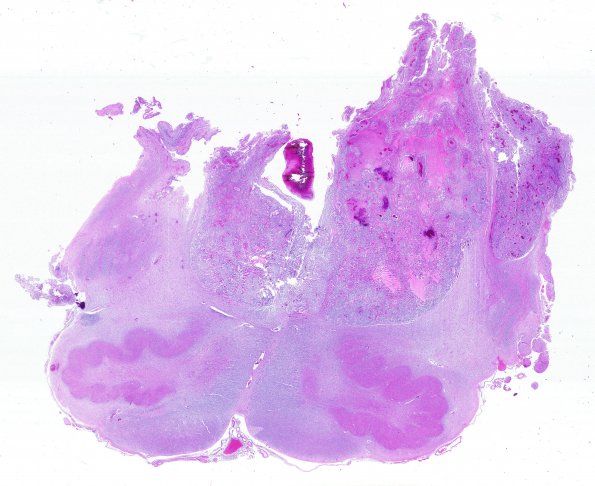 7D2 Ependymoma, anaplastic (Case 7) N8 WM