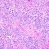 10A1 Ependymoma (Case 10A), true rosettes H&E 1.jpg