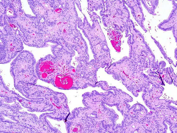 10B1 Ependymoma (Case 10B), canals H&E 1.jpg