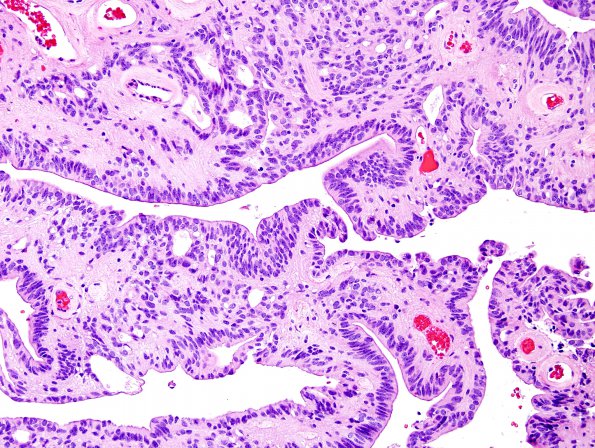 10B2 Ependymoma (Case 10B), canals H&E 4