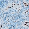 10C2 Ependymoma (Case 10C) PF-A H3K27me3 1