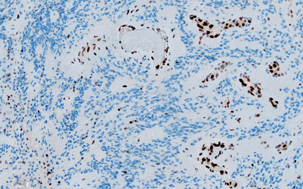 10C2 Ependymoma (Case 10C) PF-A H3K27me3 1