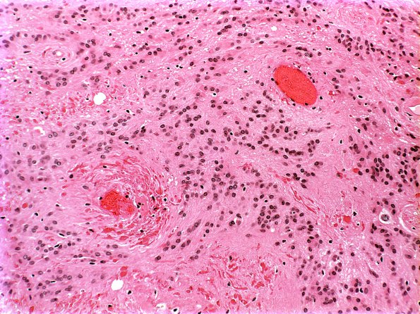 10D1 Ependymoma (Case 10D) H&E 2