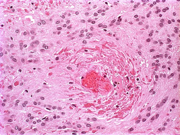 10D2 Ependymoma (Case 10D) H&E 1