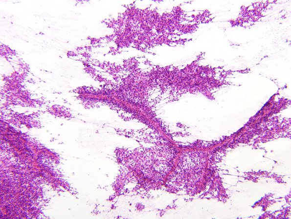 10E1 Ependymoma (Case 10E) Smear 1.jpg