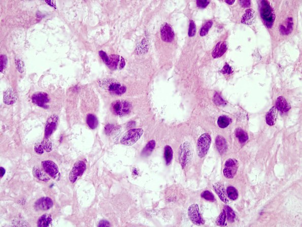 10E2 Ependymoma (Case 10E), true rosette, terminal bars H&E 5