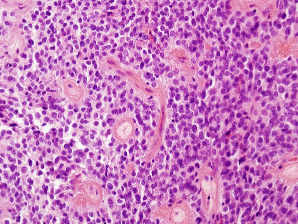 10F1 Ependymoma (Case 10F) H&E 1