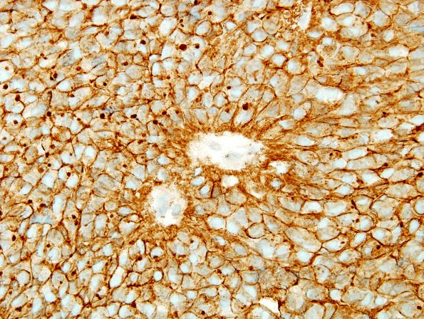 10F2 Ependymoma (Case 10F) CD99 1