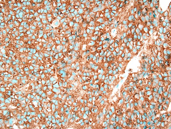 10G2 Ependymoma (Case 10G) CD99 1.jpg