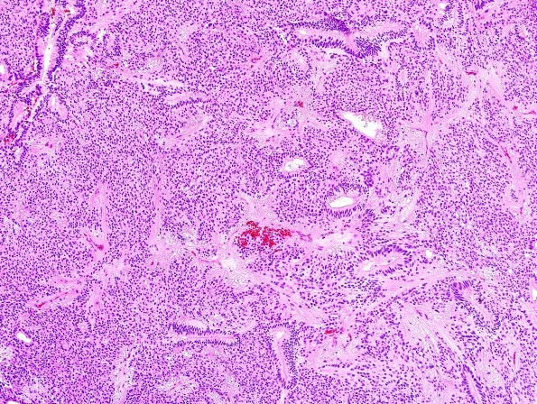 10H1 Ependymoma (Case 10H) H&E 2 granular.jpg