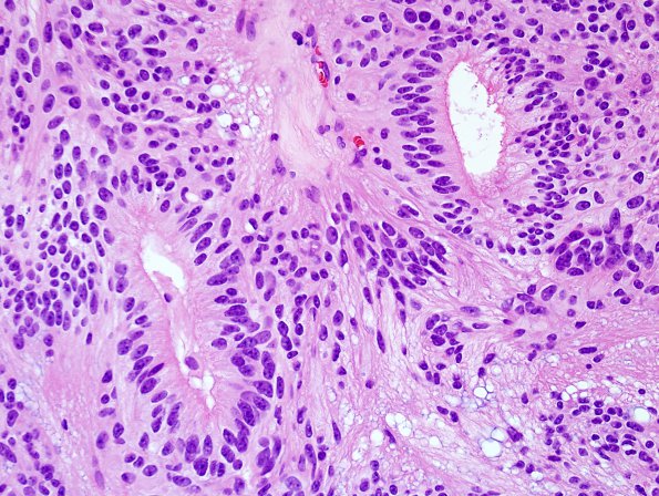 10H2 Ependymoma (Case 10H) H&E 4.jpg