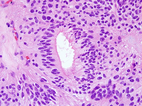 10H3 Ependymoma (Case 10H) H&E 5.jpg