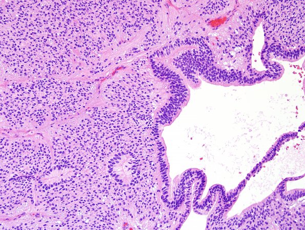 10H4 Ependymoma (Case 10H) H&E 8.jpg