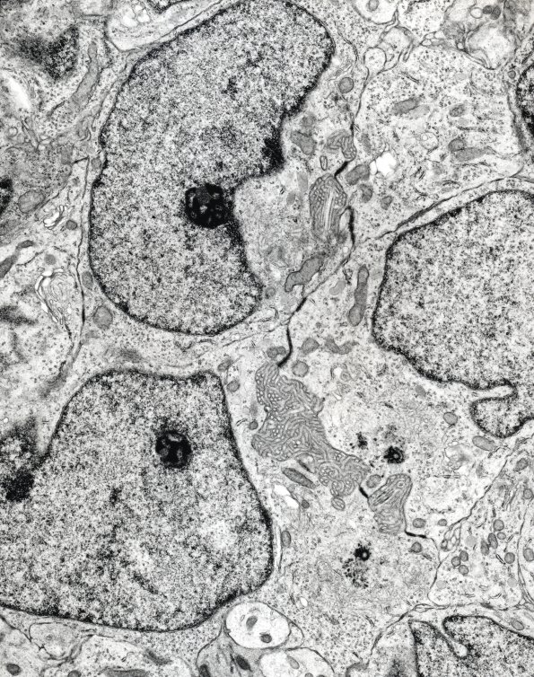 10I Ependymoma, anaplastic (Case 10I) EM - Copy