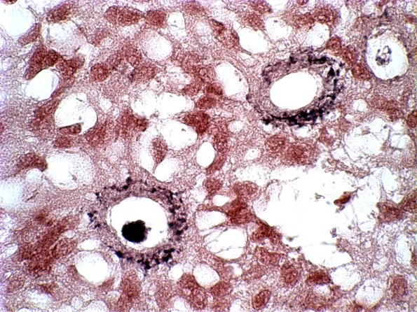 10J Ependymoma (Case 10J) PTAH