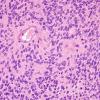 10K1 Ependymoma (Case 10K) H&E 3.jpg