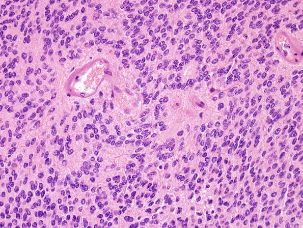 10K1 Ependymoma (Case 10K) H&E 3.jpg