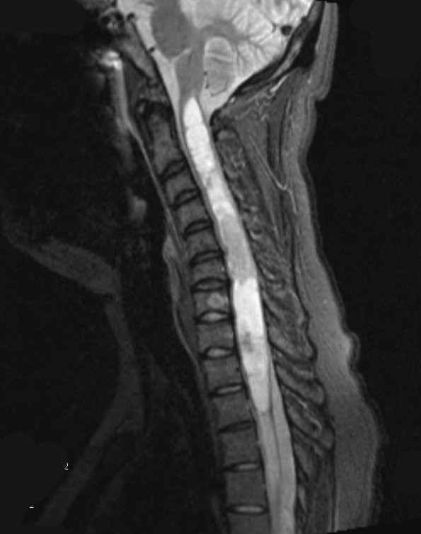 10L1 Ependymoma & Syrinx (Case 10L) STIR - Copy