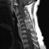 10L2 Ependymoma & Syrinx (Case 10L) T1 W - Copy