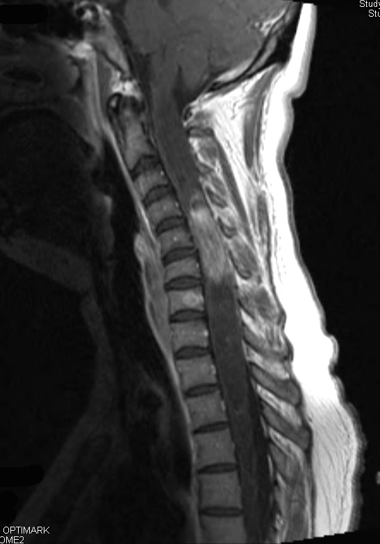 10L2 Ependymoma & Syrinx (Case 10L) T1 W - Copy