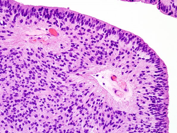 10L3 Ependymoma & Syrinx (Case 10L) H&E 2.jpg