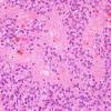 10M1 Ependymoma, WHO II (Case 10M) H&E 5.jpg