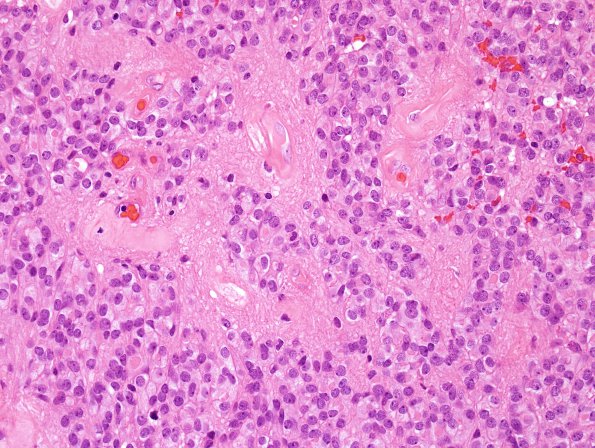 10M1 Ependymoma, WHO II (Case 10M) H&E 5.jpg