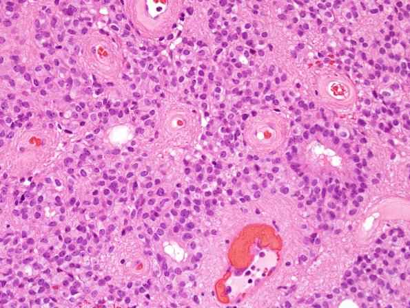 10M2 Ependymoma, WHO II (Case 10M) H&E 2.jpg