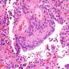 10M3 Ependymoma, WHO II (Case 10M) H&E 6.jpg