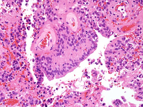 10M3 Ependymoma, WHO II (Case 10M) H&E 6.jpg