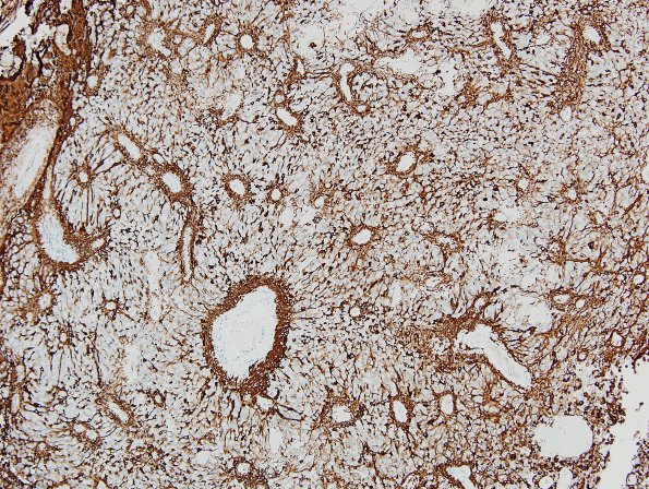 10M4 Ependymoma, WHO II (Case 10M) GFAP 4.jpg