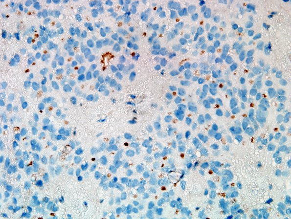 10M5 Ependymoma, WHO II (Case 10M) D2-40 4.jpg