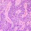 10N1 Ependymoma, anaplastic (Case 10N) H&E 6.jpg