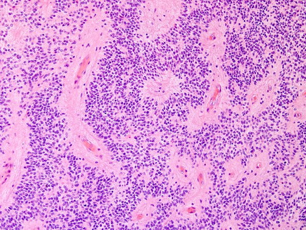 10N1 Ependymoma, anaplastic (Case 10N) H&E 6.jpg