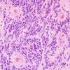 10N2 Ependymoma, anaplastic (Case 10N) H&E 3.jpg