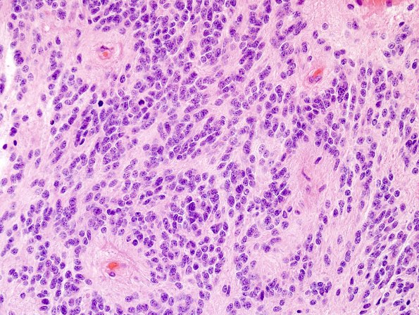 10N2 Ependymoma, anaplastic (Case 10N) H&E 3.jpg