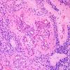 10N3 Ependymoma, anaplastic (Case 10N) H&E 9.jpg